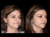 Face Before After Photos Rhinoplasty Before After Photos Case #13527 - Pancholi Cosmetic Surgery