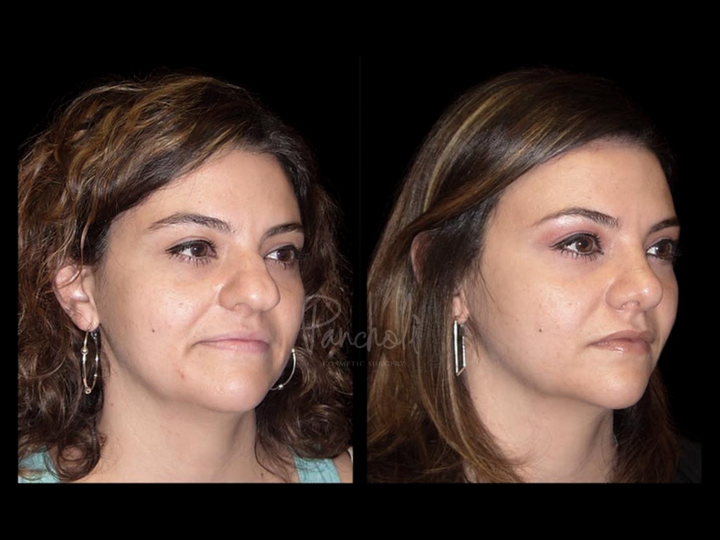 Face Before After Photos Rhinoplasty Before After Photos Case #13527 - Pancholi Cosmetic Surgery