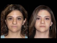Face Before After Photos Rhinoplasty Before After Photos Case #13528 - Pancholi Cosmetic Surgery