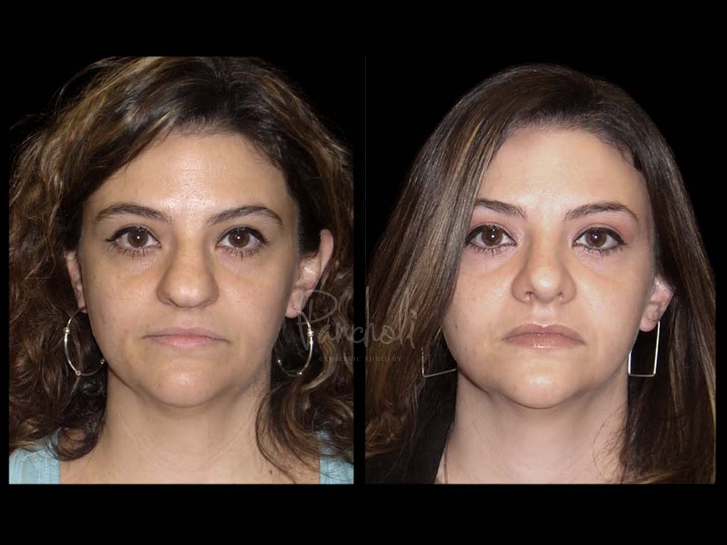 Face Before After Photos Rhinoplasty Before After Photos Case #13528 - Pancholi Cosmetic Surgery