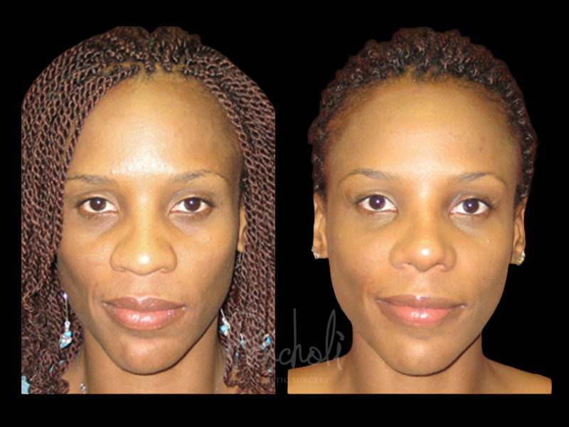 Rhinoplasty Front View Female 10887 Case #13650 - Pancholi Cosmetic Surgery