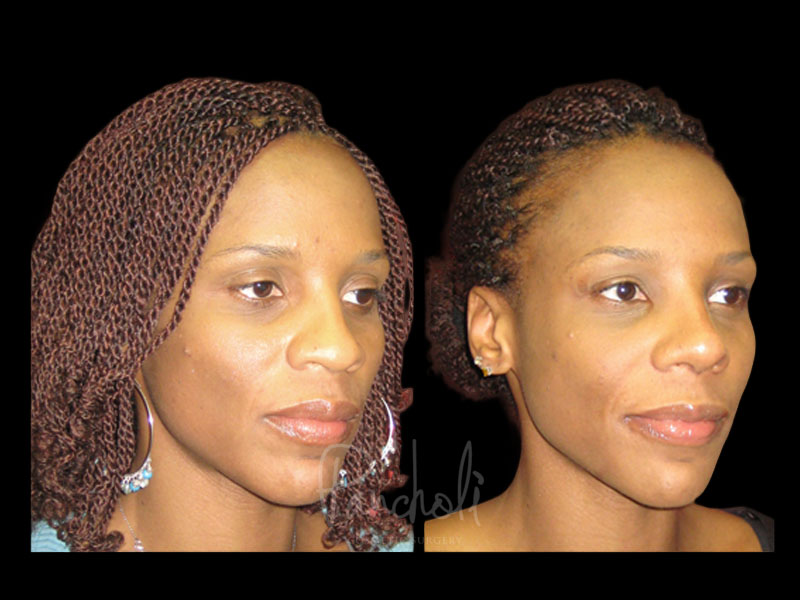 Rhinoplasty Angle View Female 10887 Case #13651 - Pancholi Cosmetic Surgery