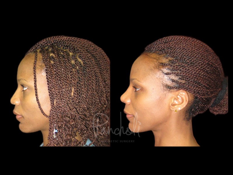 Rhinoplasty Side View Female 10887 Case #13652 - Pancholi Cosmetic Surgery