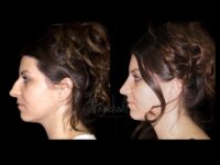 Rhinoplasty Before After Photos Case #13517 - Pancholi Cosmetic Surgery