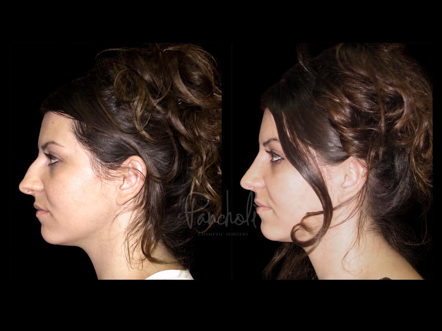 Rhinoplasty Before After Photos Case #13517 - Pancholi Cosmetic Surgery