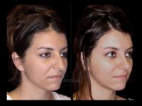 Rhinoplasty Before After Photos Case #13518 - Pancholi Cosmetic Surgery