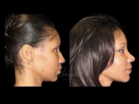 Rhinoplasty Before After Photos Case #13520 - Pancholi Cosmetic Surgery