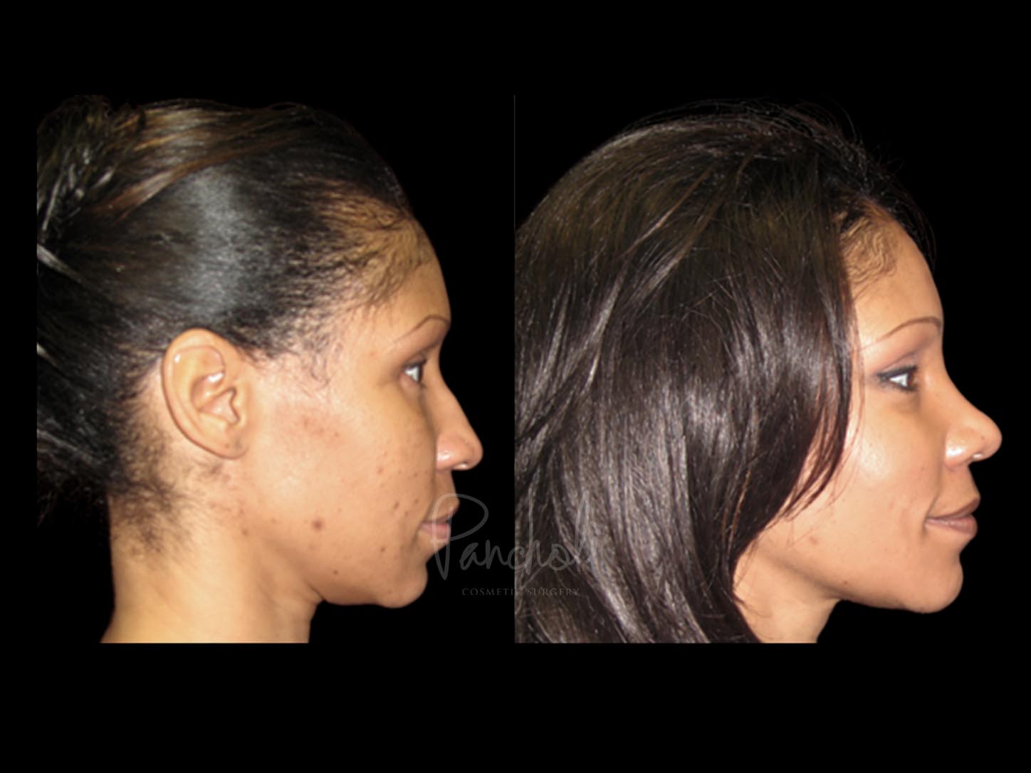 Rhinoplasty Before After Photos Case #13520 - Pancholi Cosmetic Surgery