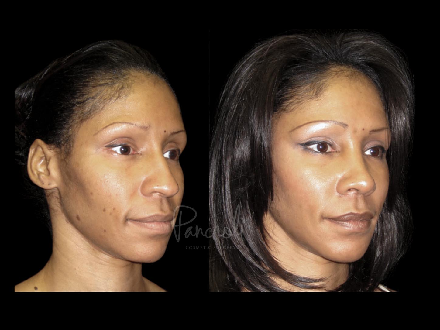 Rhinoplasty Before After Photos Case #13521 - Pancholi Cosmetic Surgery