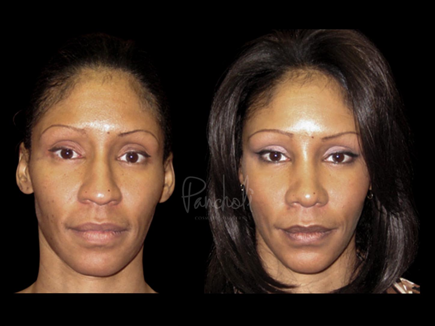 Rhinoplasty Before After Photos Case #13522 - Pancholi Cosmetic Surgery