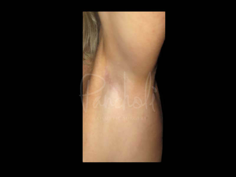 Transaxillary Breast Augmentation Scar Before After Photos Case #13404 - Pancholi Cosmetic Surgery