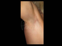 Transaxillary Breast Augmentation Scar Before After Photos Case #13405 - Pancholi Cosmetic Surgery