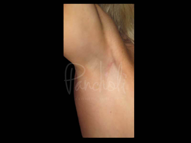 Transaxillary Breast Augmentation Scar Before After Photos Case #13405 - Pancholi Cosmetic Surgery